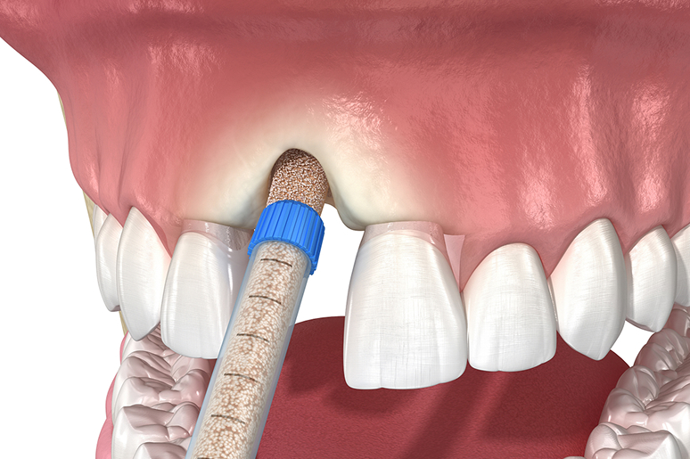 Illustration of a bone graft procedure