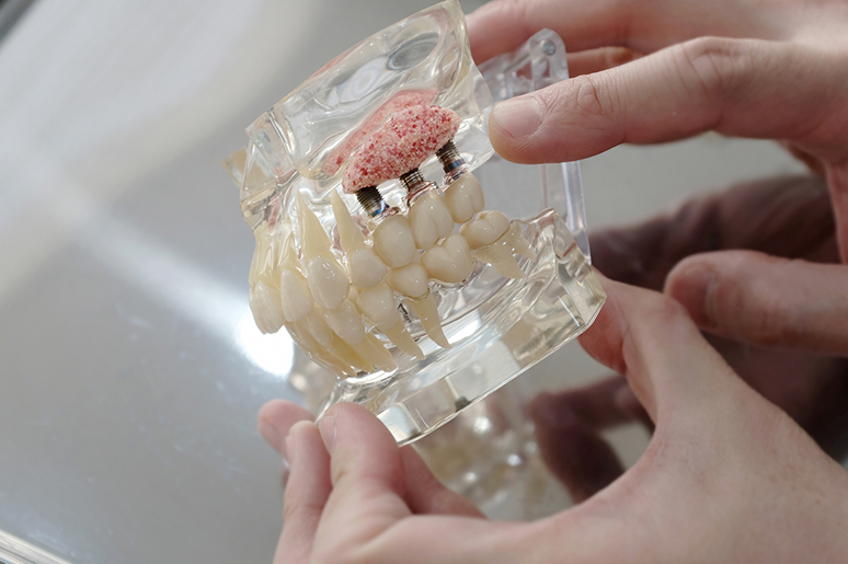 Dental model showing a bone graft and implant