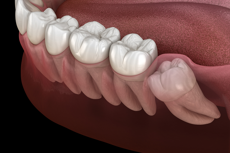 Illustration of an impacted wisdom tooth